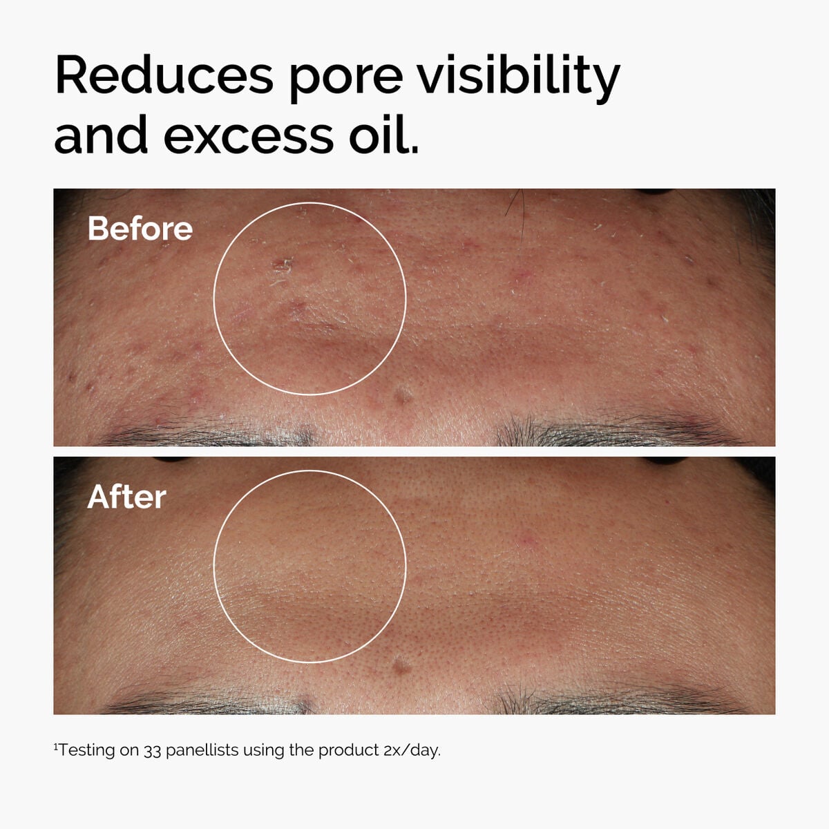 niacinamide-10-zinc-1-f3 ord-niacinamide-zinc-blemish-serum-before-after-pores.jpg
