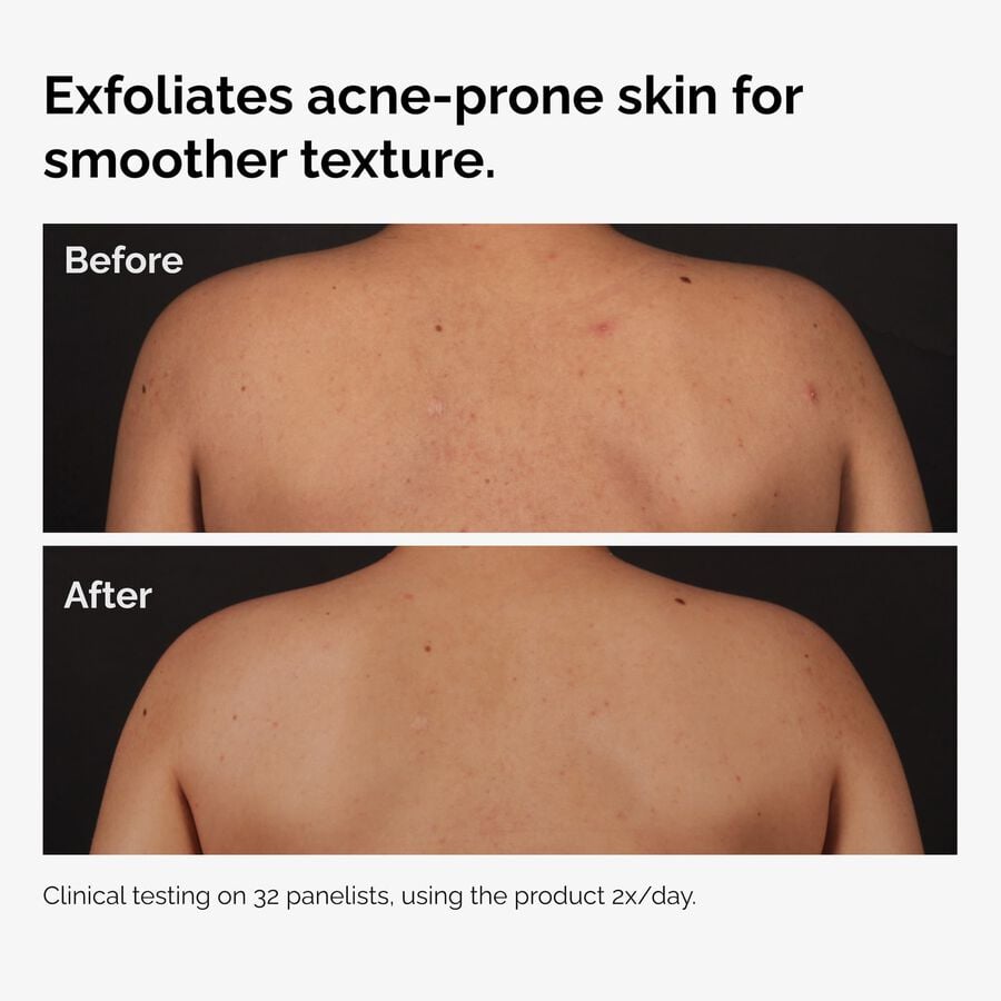 the-body-care-collection-v4 ord-salicylic-acid-body-serum-before-after-graphic-NA.jpg